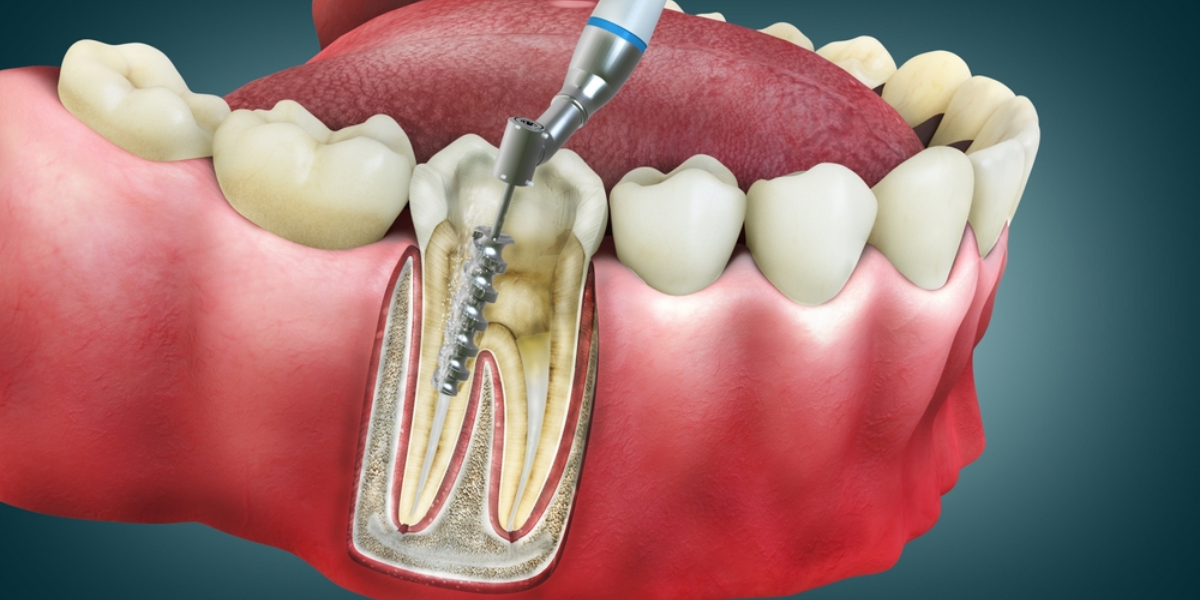 10 Signs You Might Need a Root Canal Treatment