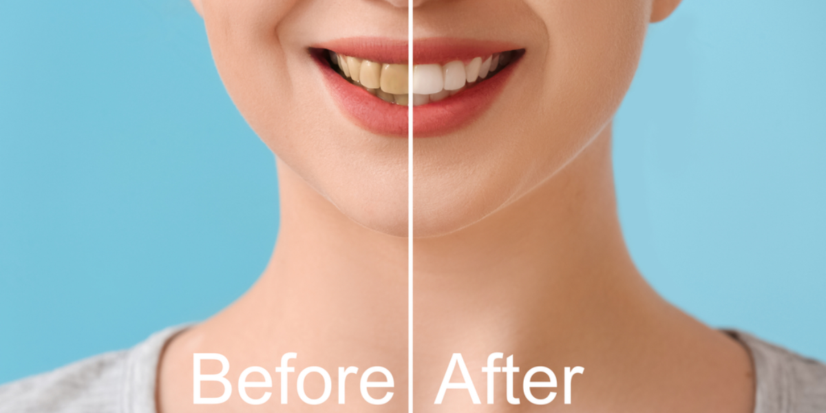 Does Teeth Scaling And Polishing Make Teeth Whiter