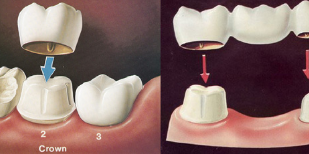 How Dental Crowns and Bridges Can Transform Your Oral Health