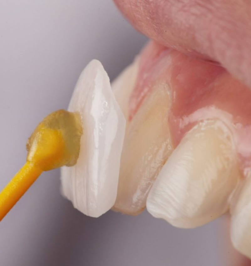 Best Porcelain Veneers in Abu Dhabi