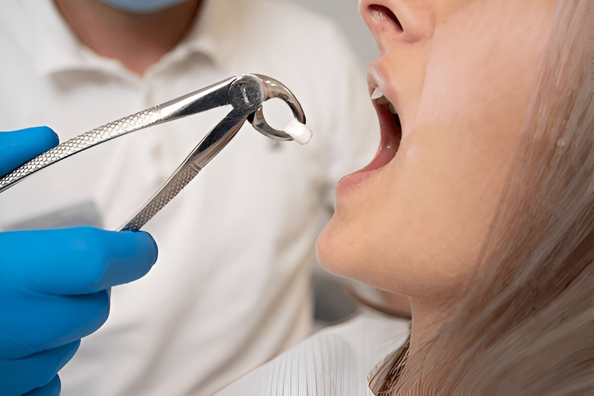Common Tooth Extraction Myths Debunked