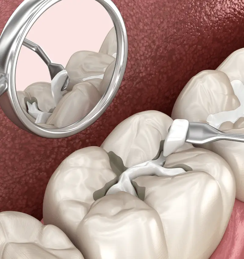 Best Dental Filling in Abu Dhabi