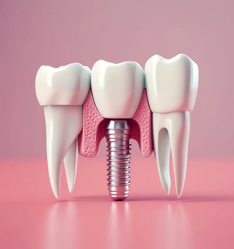 Best Dental Implant Clinic in Abu Dhabi