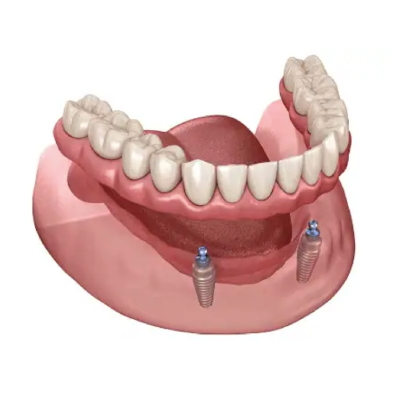 Fixed Dentures Abu Dhabi