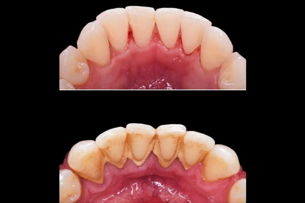 Gingivitis Gum Disease Treatment