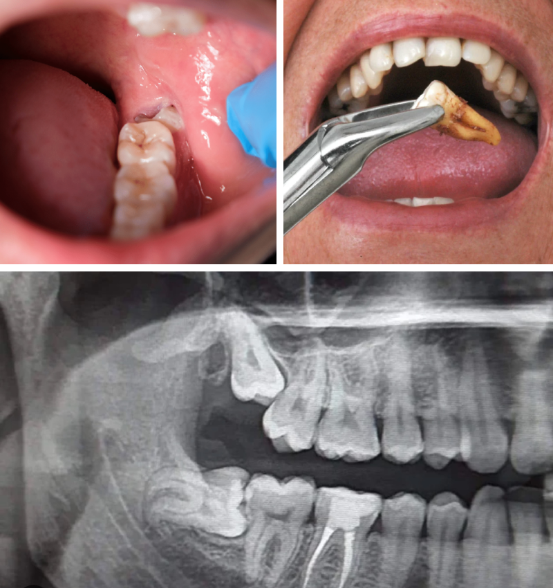 Impacted Wisdom Tooth Extraction