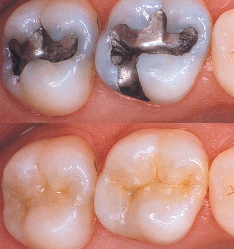 Best Teeth Filling in Abu Dhabi