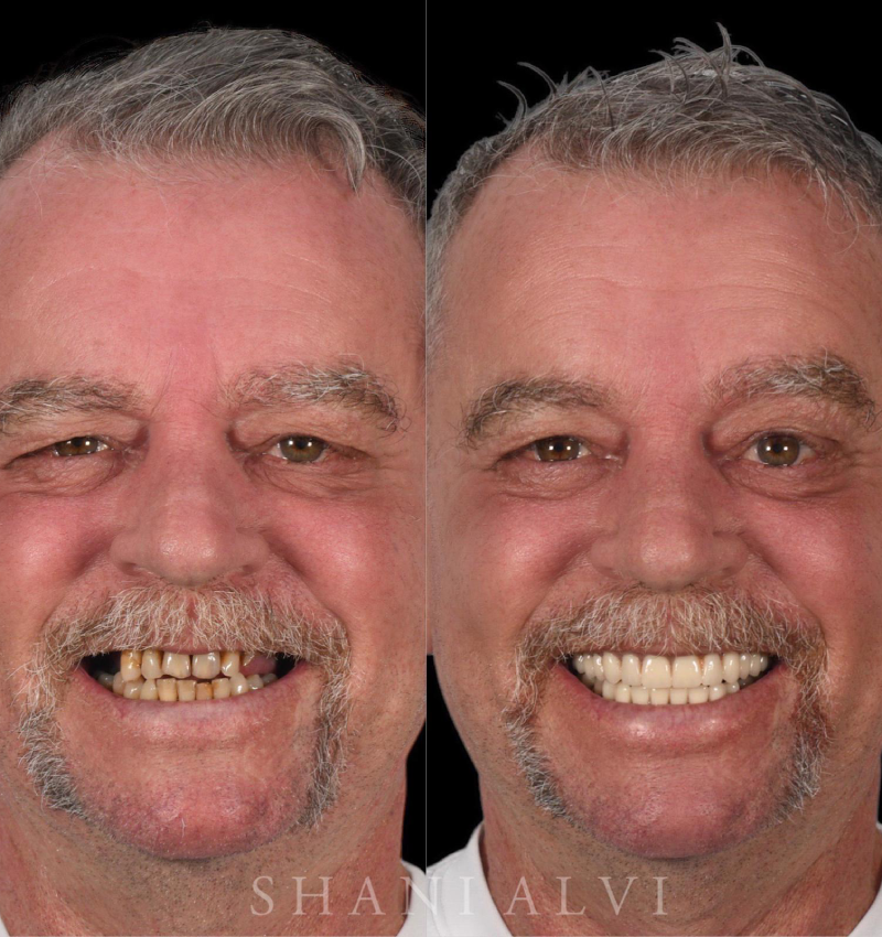Prosthodontic Treatment in Abu Dhabi
