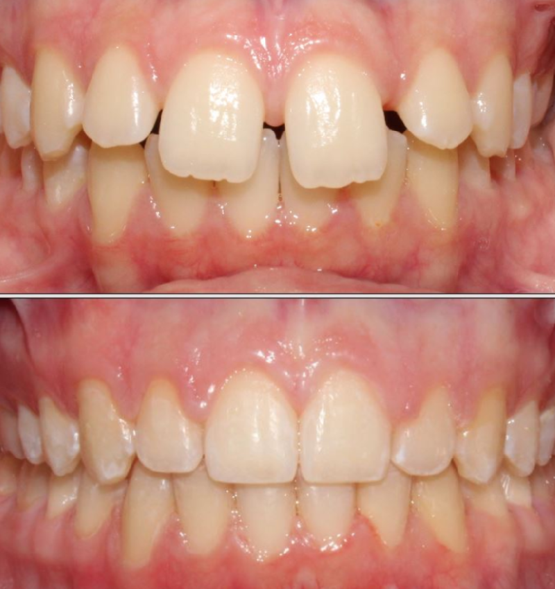 Tooth Cap in Abu Dhabi