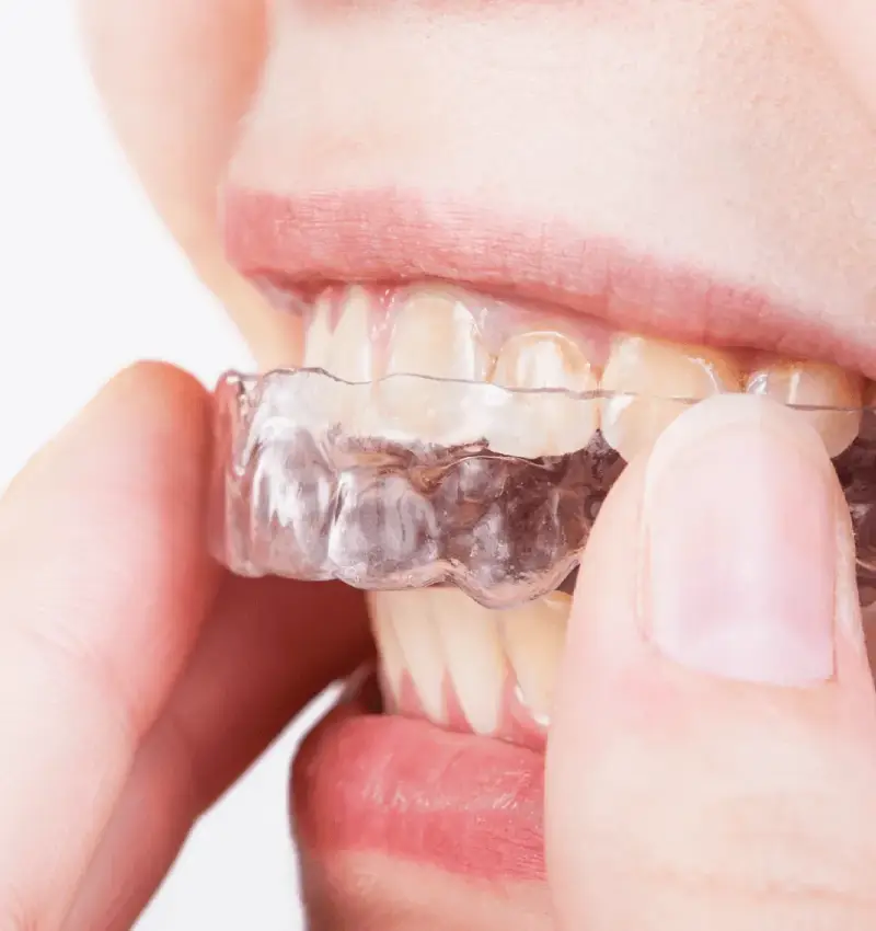 Best Custom-Made Night Guard in Abu Dhabi