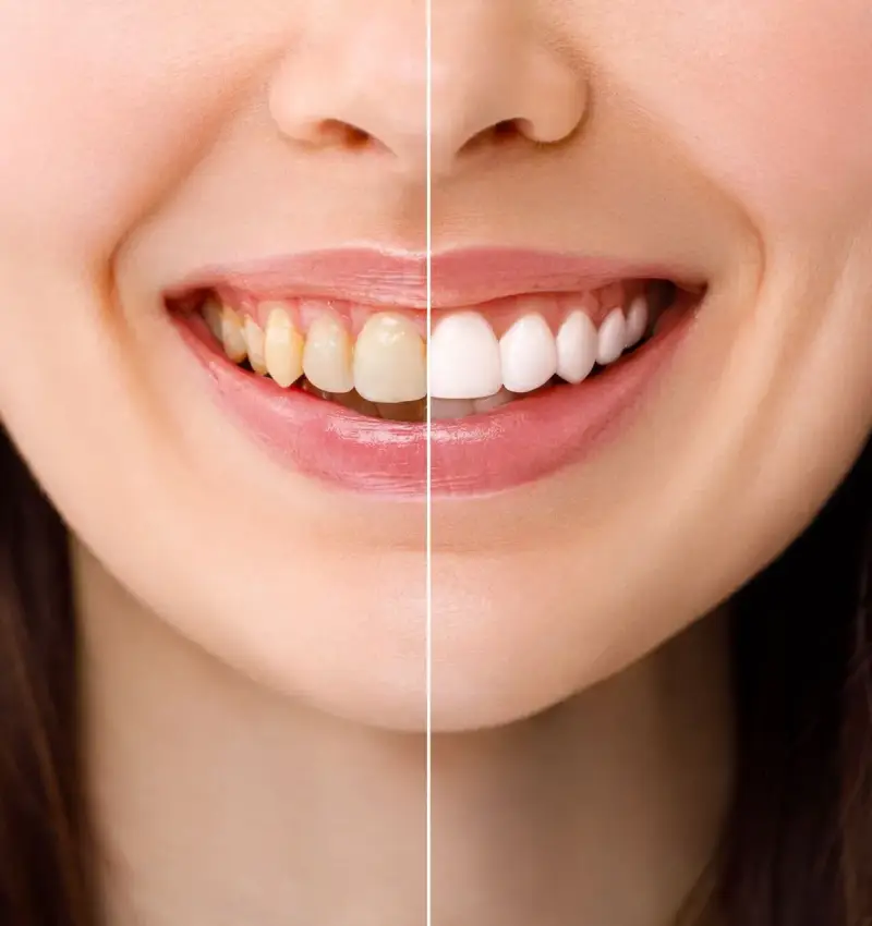 Teeth Whitening Services in Abu Dhabi