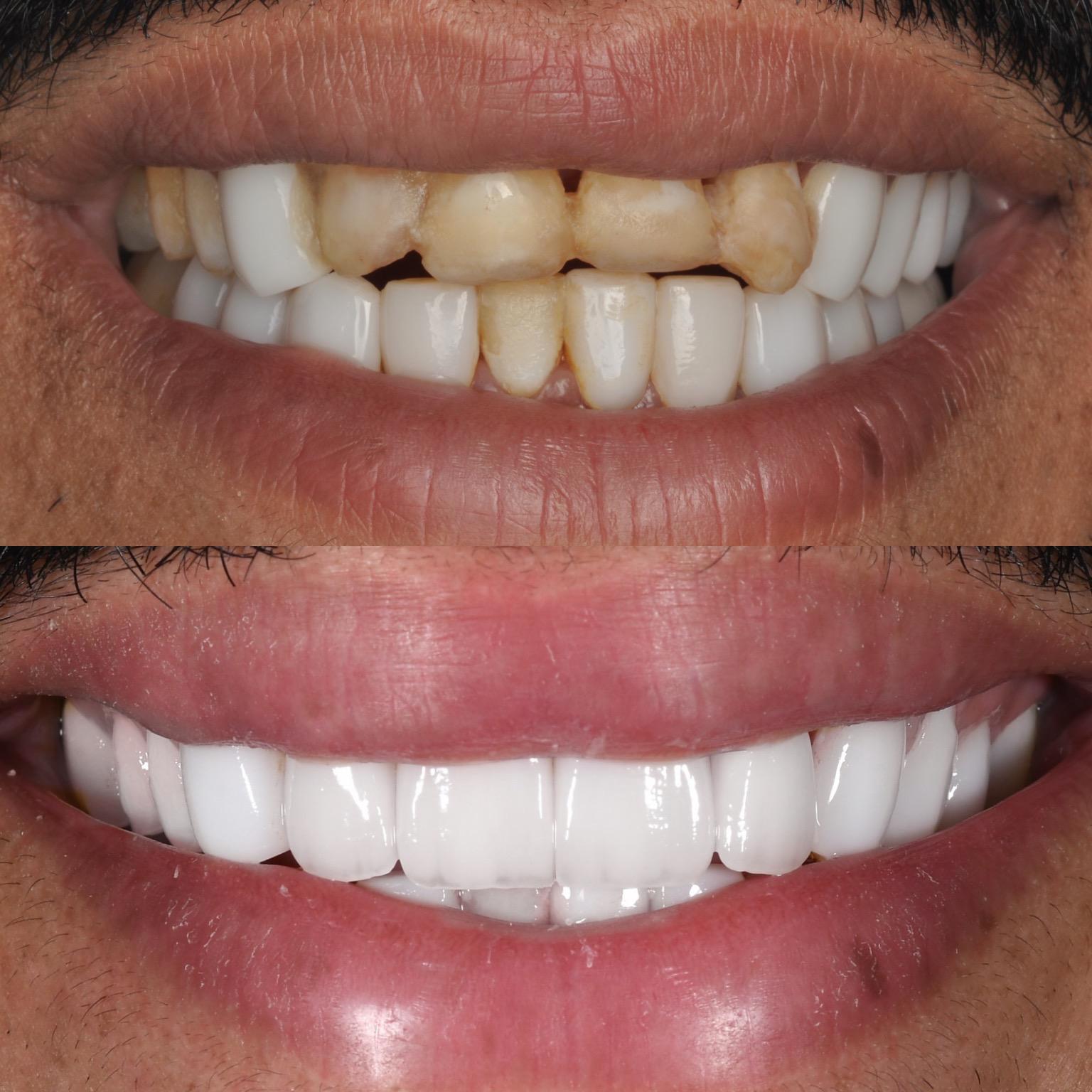 Before and After Teeth Veneers