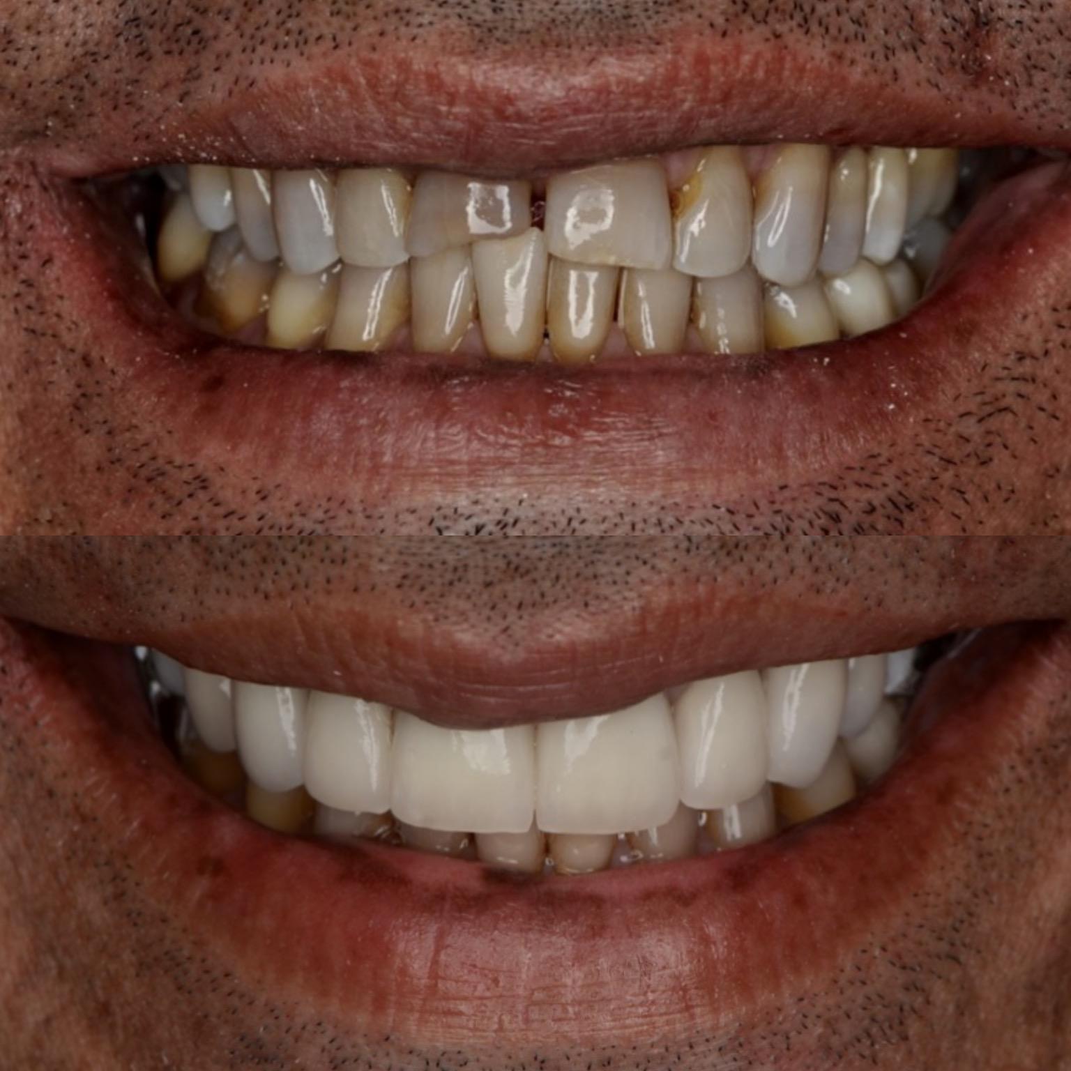 Best Dental Veneers in Abu Dhabi