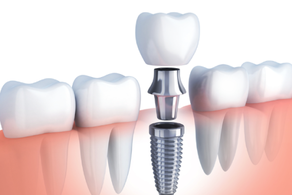 Dental Implants for Missing Teeth