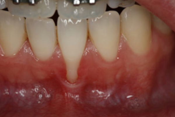 Gum Recession Treatment