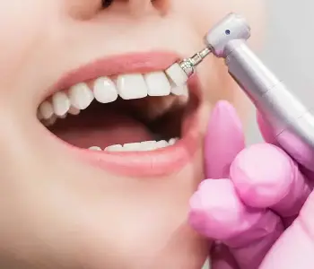 Teeth Cleaning Scaling and Polishing
