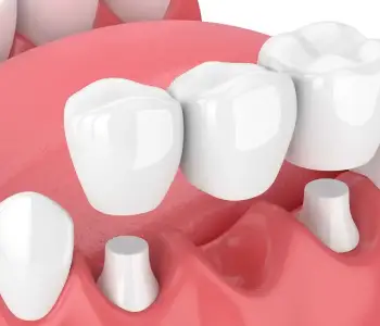 Dental Crowns and Bridges