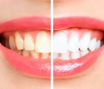 Teeth Whitening