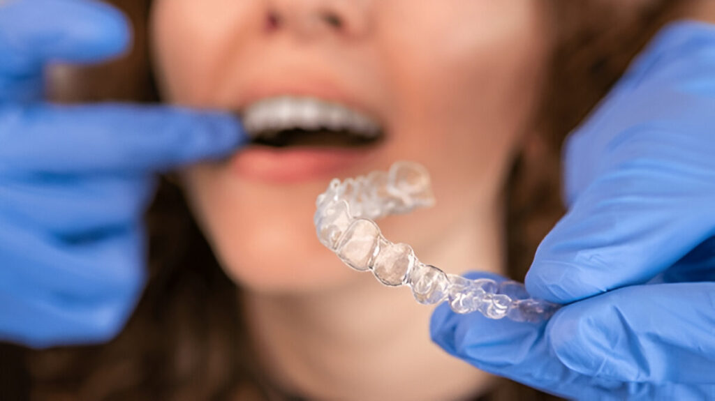 Retainers After Braces Types, Benefits, and How to Take Care