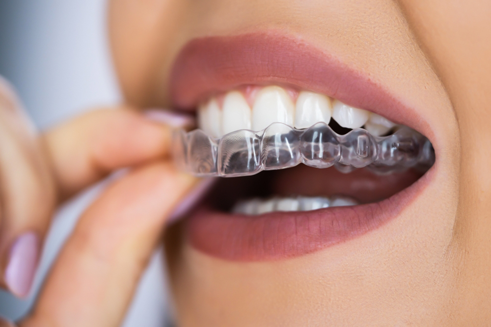 Clear Aligners (Invisalign Braces) – The Invisible Choice