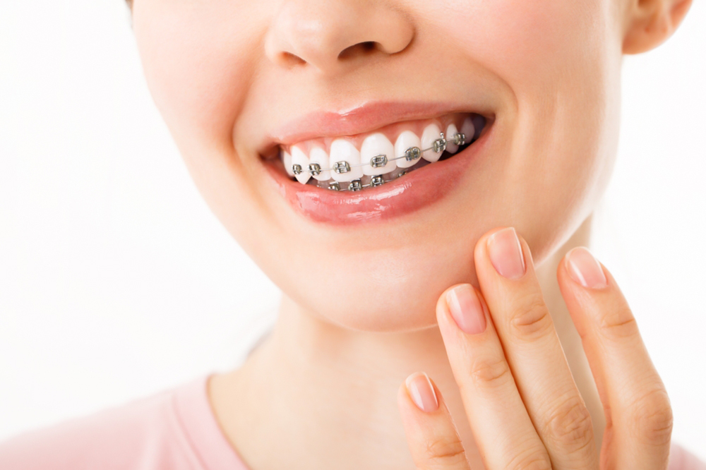 Metal Braces (Traditional Silver Braces) – Classic and Reliable