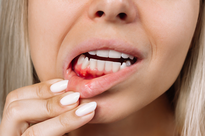 Periodontal (Gum) Disease Causes, Symptoms & Treatment