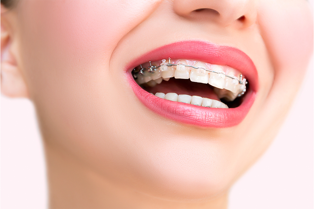Self-Ligating Braces – Modern & Efficient