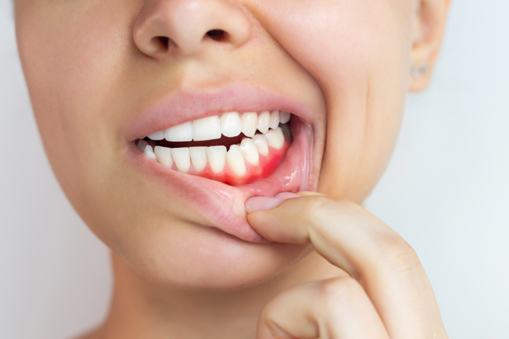 What Exactly Is Periodontal (Gum) Disease 