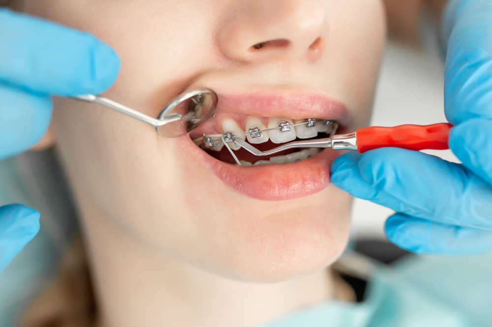 Why Choose Marigold Dental & Orthodontic Clinic for Dental Braces