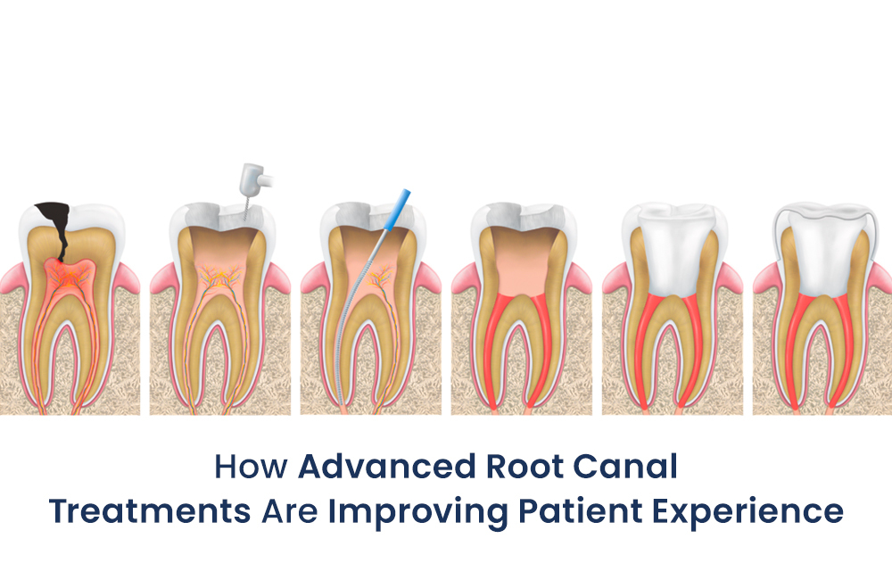 How Advanced Root Canal Treatments Are Improving Patient Experience