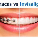 braces vs Inviaslign
