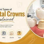 Different Types of Dental Crowns Explained
