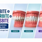 overbite crossbite and underbite