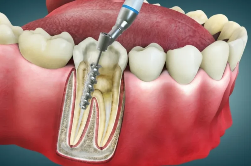 10-Signs-You-Might-Need-a-Root-Canal-Treatment