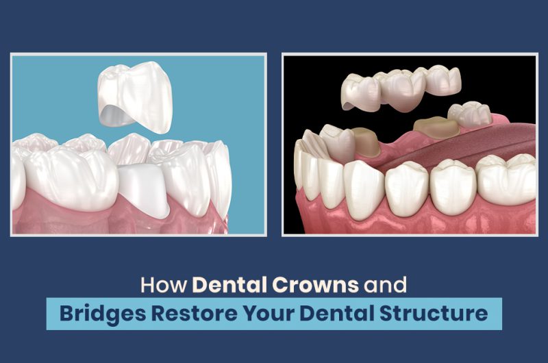 Dental Crowns and Bridges Restore Your Dental Structure