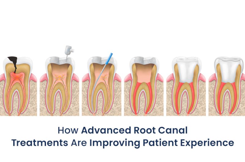 How Advanced Root Canal Treatments Are Improving Patient Experience