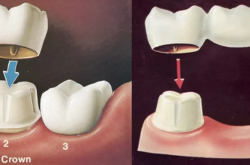 How-Dental-Crowns-Bridges-Can-Transform-Your-Oral-Health