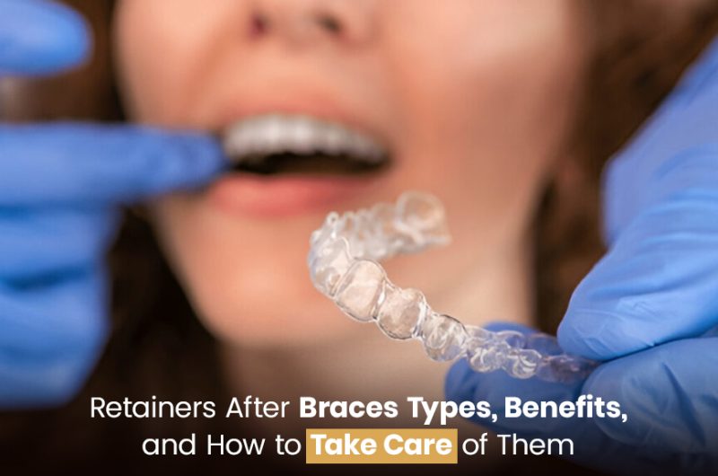 Retainers After Braces