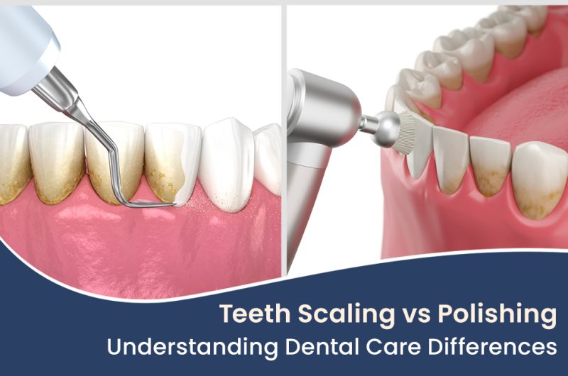 Teeth Scaling vs Polishing Understanding Dental Care Differences