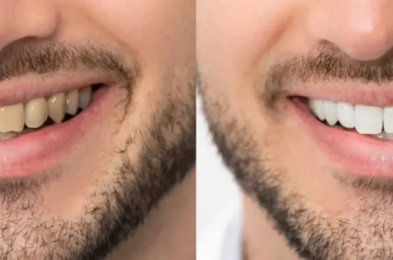 Teeth-Whitening-Myths-and-Facts-You-Should-Know