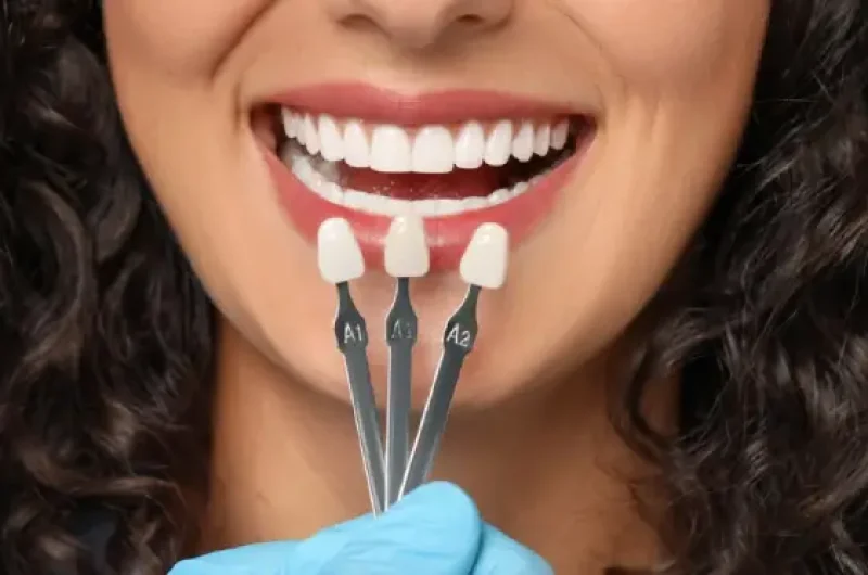 Thinking-About-Getting-Veneers