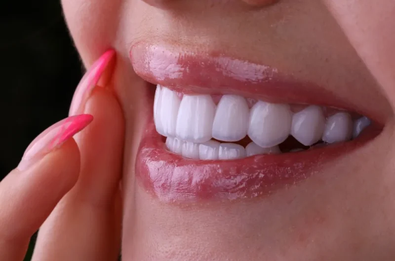 What Is a Hollywood Smile