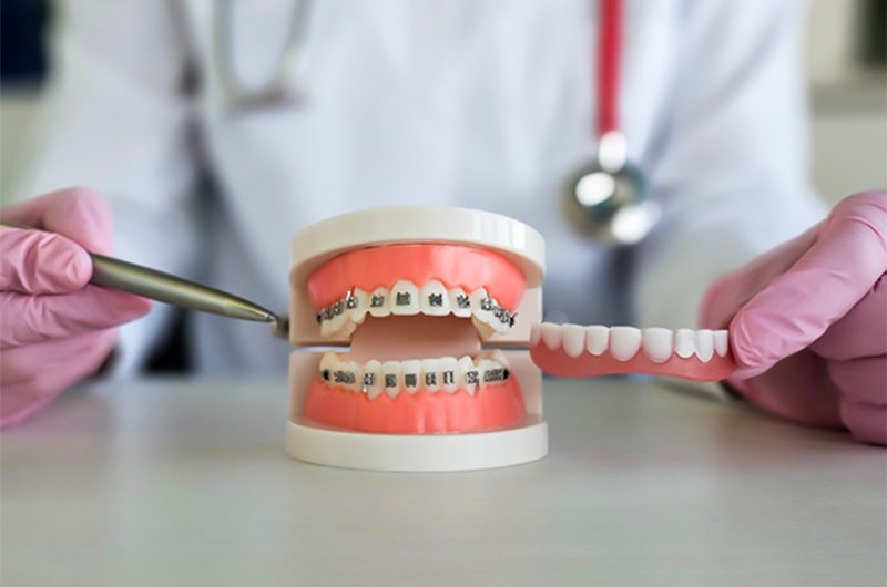 What are the different types of braces