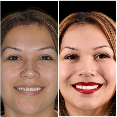 Before and After Dental Treatment