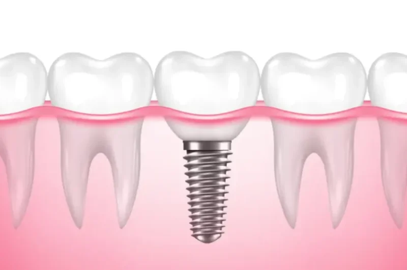 Why-Tooth-Implants-are-the-Best-Long-Term-Solution
