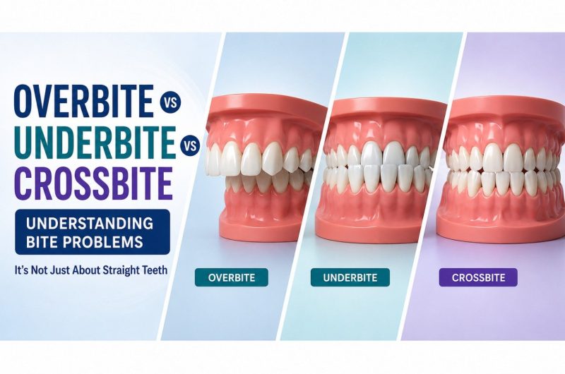 overbite crossbite and underbite