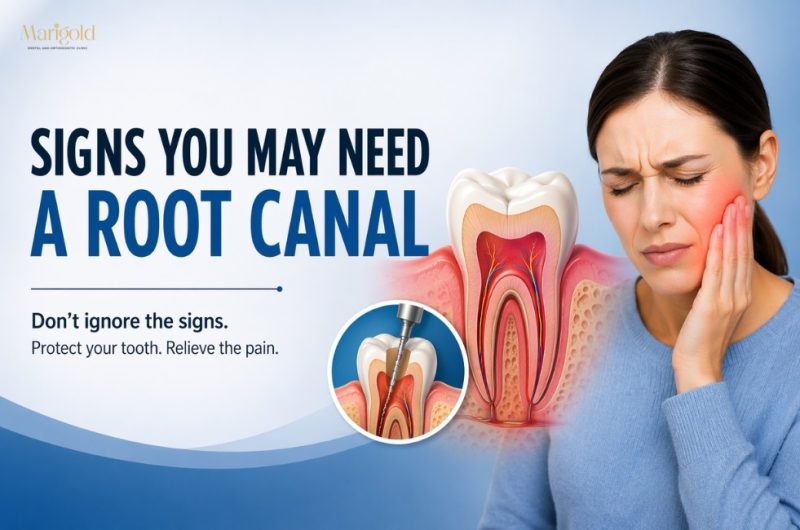 Signs You Need a Root Canal